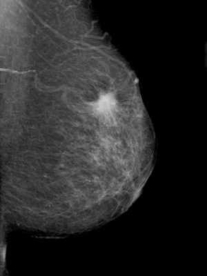 2014年10月に乳がんを知らされる