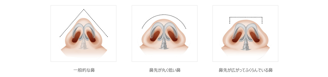 鼻が高い人と大きい人の軟骨の形状の違い